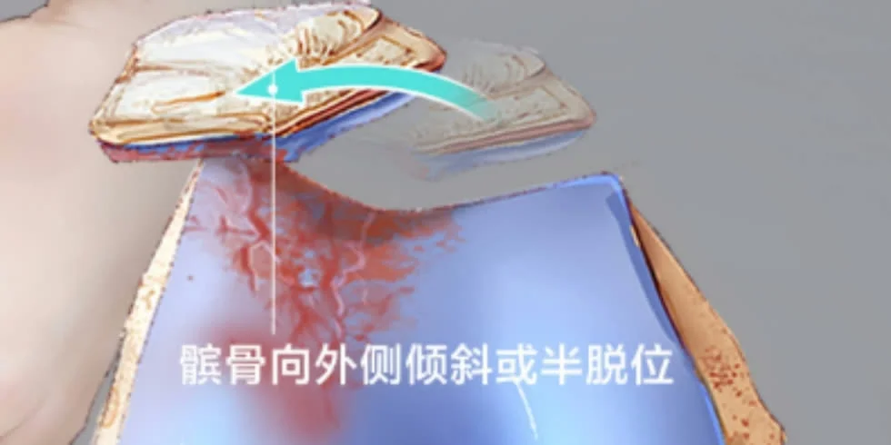 髌骨外侧倾斜或半脱位示意